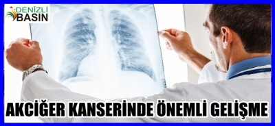AKCİĞER KANSERİNDE ÖNEMLİ GELİŞME