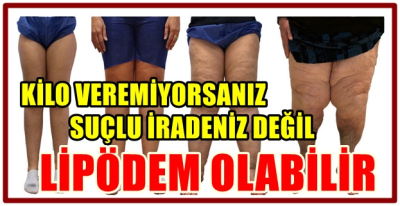 KİLO VEREMİYORSANIZ SUÇLU İRADENİZ DEĞİL, LİPÖDEM OLABİLİR