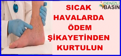SICAK HAVADA ÖDEM ŞİKAYETLERİNDEN KURTULUN